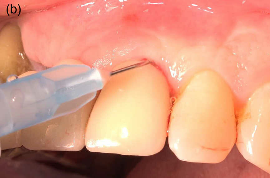 Fig 1 (b) : Injection d’hypochlorite de sodium à 0,95 % dans le sillon gingivo-dentaire, attente de 30 secondes pour un ramollissement du tissu de granulation et sa préparation pour une dégranulation par une curette.