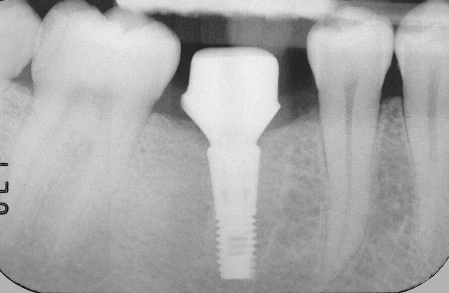Fig. 15: Verification of correct seating of the abutment using a radiographic image. Note that the transitional portion of the abutment followed the contour of the bone.