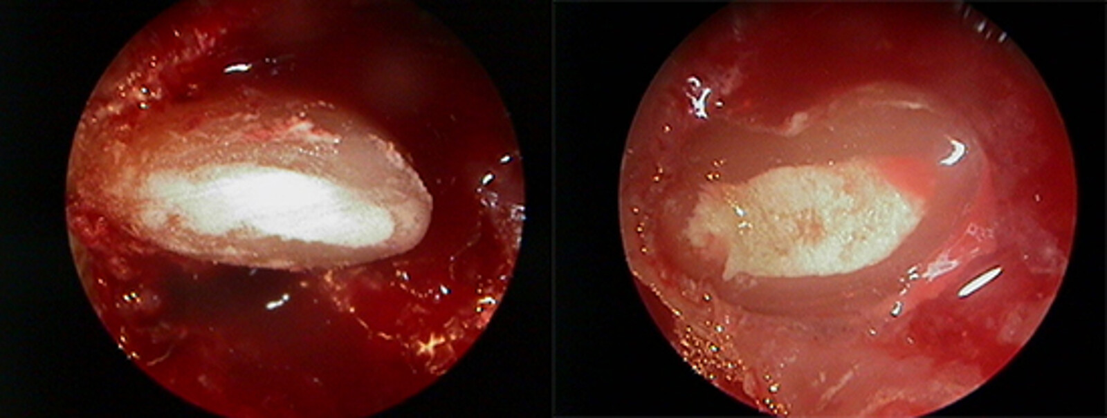 Figura 7 y 8. Vistas de endoscopio de la obturaciÃ³n.