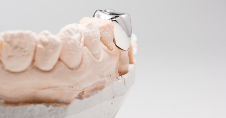 Study proves effectiveness of stainless-steel crowns