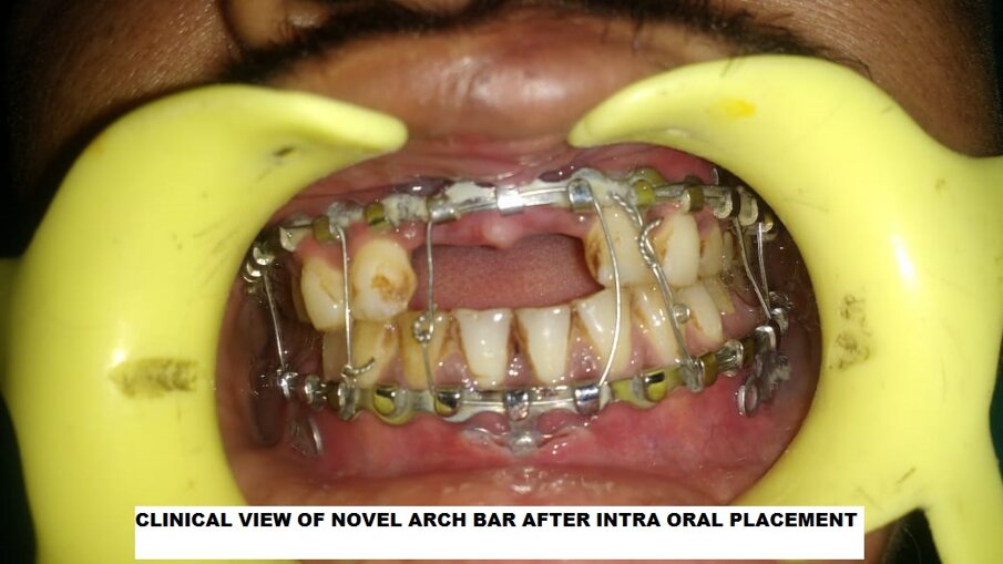 Fig 3: Clinical view of the Novel Arch Bar after intraoral placement