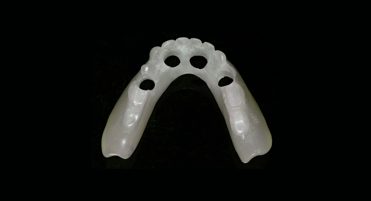 Fig. 3: Duplication of an acceptable denture serves as a custom tray. Holes of sufficient diameter to accommodate impression copings have been prepared.