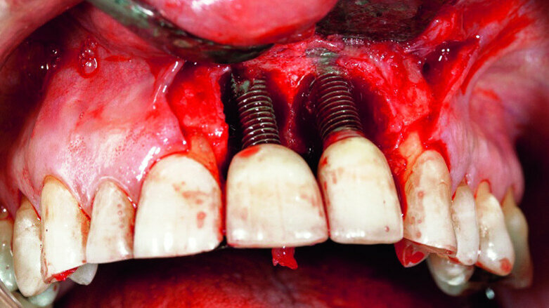 Peri-implantitis therapy - Using resorbable bone replacement material