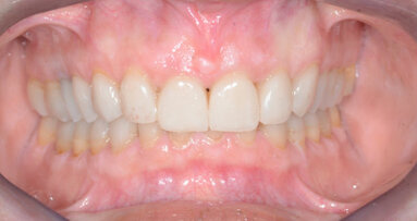 Un nuovo sorriso grazie alla Medicina Estetica Odontoiatrica