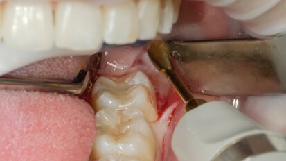 Nuovo protocollo estrattivo piezoelettrico nella chirurgia del dente del giudizio