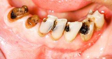 Billions to suffer from untreated tooth decay