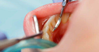 O estudo oferece novos conhecimentos sobre o desenvolvimento e prevenção da cárie dentária