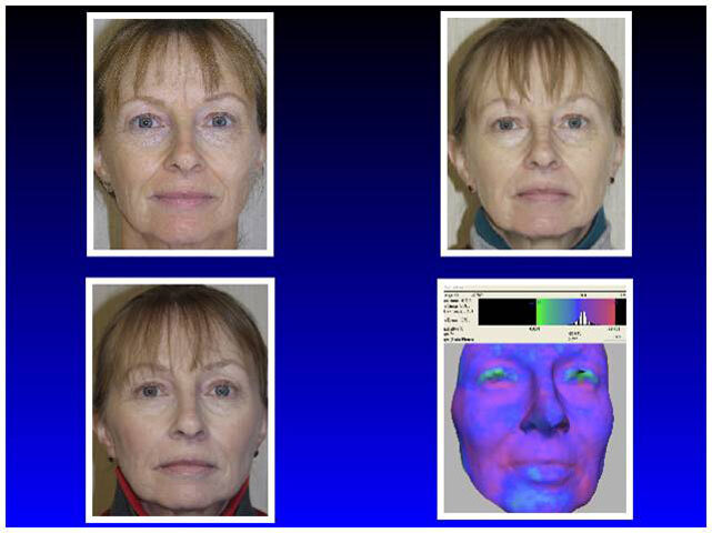 Fig. 3: The pretreatment face, the post-treatment face at six months and nine months, and finally, a morphometric evaluation of the change.