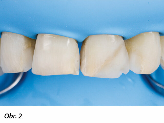 Zajištění suchého pracovního pole po očištění, dezinfekci a vyleštění povrchu zubů.
