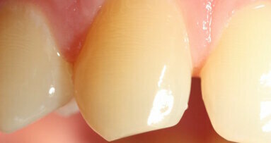 Exposição precoce ao BPA pode afetar negativamente a formação do esmalte dentário