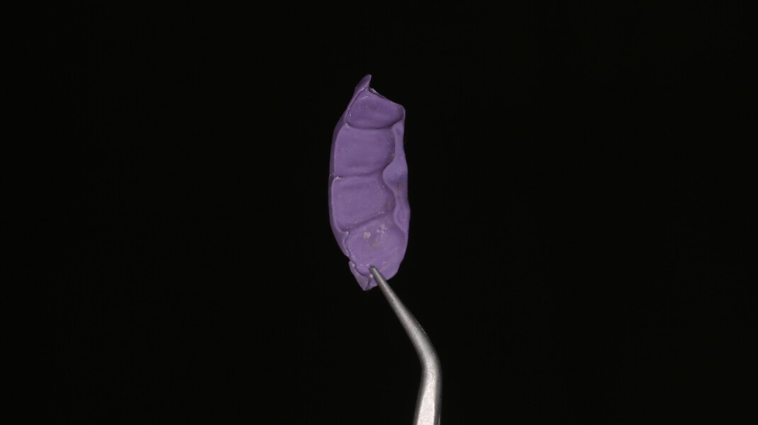 Fig 7: Once verified, a putty index was made with A-Silicone to record the palatal surface.