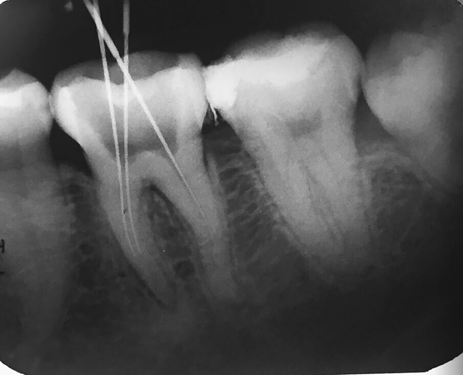 Radiograph from referred dentist