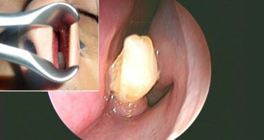 Supernumerary tooth grows in man’s nose