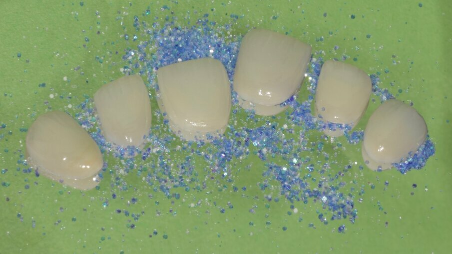 Fig. 10: Ceramic partial fixed dental prostheses (veneers) before try-in and bonding procedures.