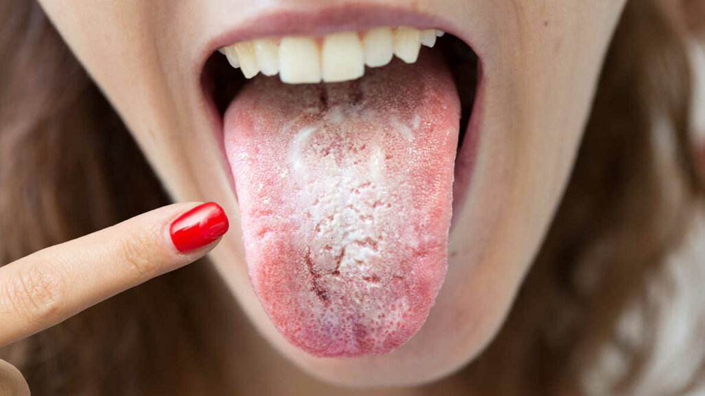 „COVID jezik“ – stomatolozi ukazuju na važnost primjećivanja simptoma u usnoj duplji