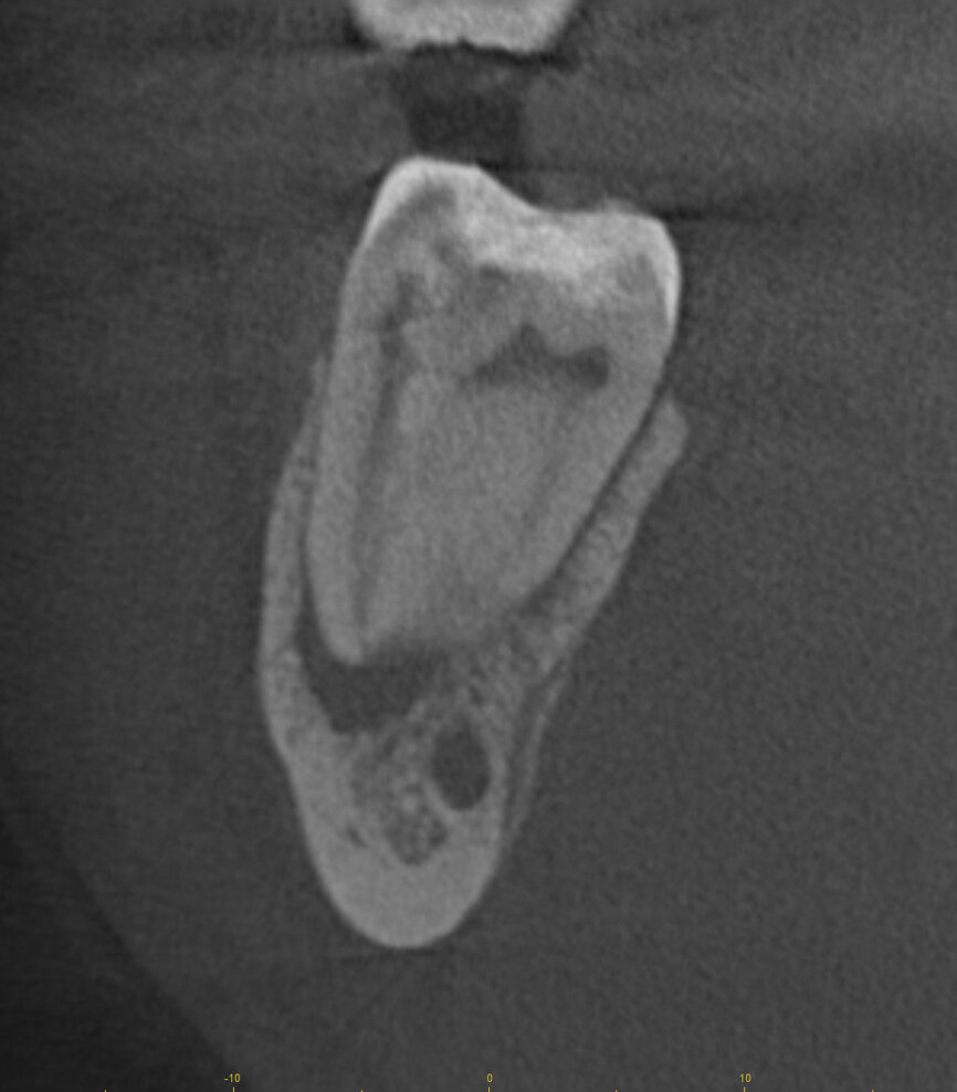 Fig. 15e: Cased treated with PIPs (Photon Induced Photoacoustic Streaming). Note the orifice barrier placed in composite to protect the endodontic treatment from coronal leakage. (Courtesy of Dr. Paula Elmi)
