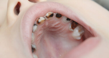 Early preventive dental care may not reduce caries risk