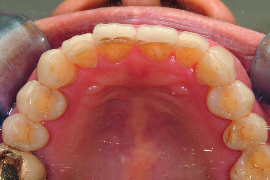 Fig. 22: Try-in: incisal view of upper anterior dentition.
