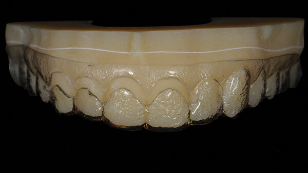 Fig. 5. Modelo impreso tridimensionalmente de la planificación del diseño de sonrisa digital, con una estructura de mock-up. Se introdujo una abertura cervical para acceso quirúrgico y como guía para alargar las coronas.