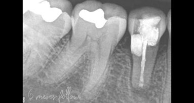 Riassorbimento della radice cervicale esterna nella zona mandibolare anteriore: diagnosi e alternative terapeutiche