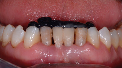 Dental veneers - Studio Benzi - Dental Clinic Vigevano