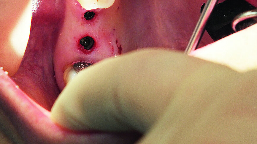 Fig. 17: Subcrestal implant placement.