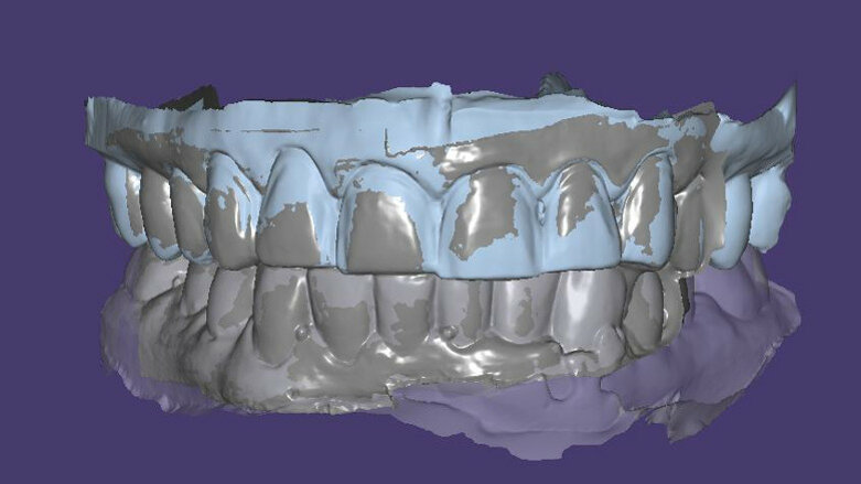 Digital face-bow transfer technique dentofacial analyser for dental aesthetics