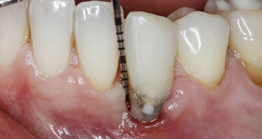 Management kosti a měkkých tkání při komplexní rekonstrukci jednoho zubu implantátem