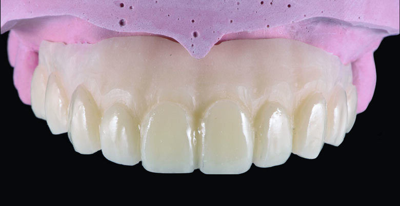 Fig 12. cutback was made to create gingival space for pink composite layering.