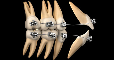 Přehled klinické ortodoncie: Mechanika léčby, část I.