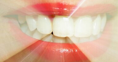 Prawdy i mity o wybielaniu zębów