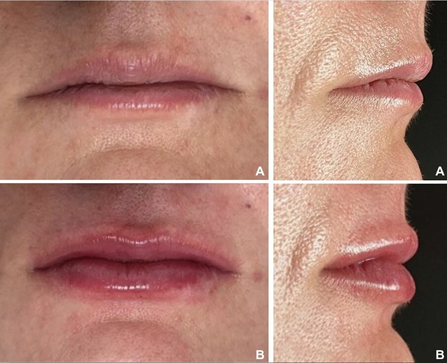 Patiënt uit de groep met dunnere lippen (a) voor lipvergroting en (b) tien dagen na lipaugmentatie (foto: De Queiroz Hernandez et al., licensed under CC BY 4.0)