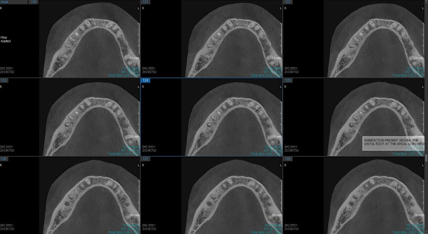 Fig.2f: Pre-op CBCT images of tooth #46: No obturation material in the distal and mesiobuccal canal (a); scanty obturation of the canals and breach of the floor of the pulp chamber, no obturation beyond a few millimetres down the orifice (b & c); radiolucency in the furcation area and periapical region of both roots (d -g).