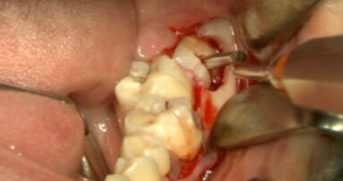 Chirurgia piezoelettrica vs strumenti rotanti nelle estrazioni dei terzi molari inferiori