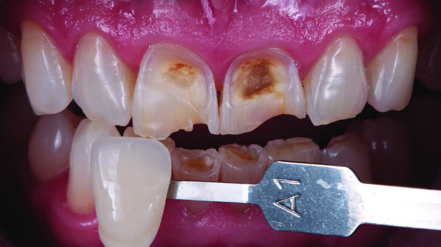 Tooth shade was determined with the aid of the VITA classical A1-D4® shade guide. The shade A1 matched the sound tooth structure. This corresponded with 3M™ Filtek™ Universal Restorative’s A1 shade.
