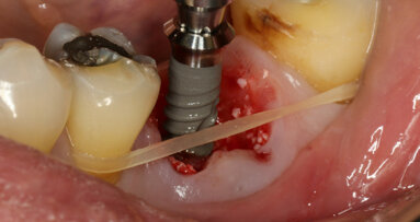 Straumann TLX: Immediate placement and loading in mandibular first molar position with follow-up
