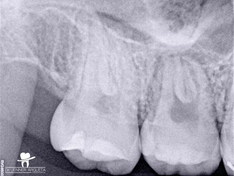 Fig. 6 : Radiographie postopératoire après huit mois. La zone rétromolaire est cicatrisée, mais la dent transplantée présente des signes de nécrose pulpaire et de pathologie périapicale. 
