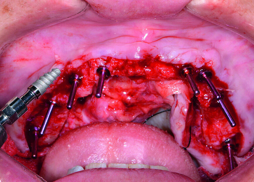 Fig. 11: Hahn dental implant being inserted.
