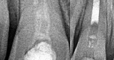 Revaskularizacija nekrotične pulpe u predelu apeksa zuba nezavršenog razvoja korena