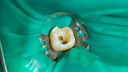 Endodontists stress importance of closing dental dam gap