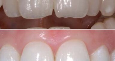 Inman Aligner: Korigovanje položaja zuba, beljenje i izrada direktnih adhezivnih restauracija – progresivni pristup preoblikovanju izgleda osmeha (Drugi deo)