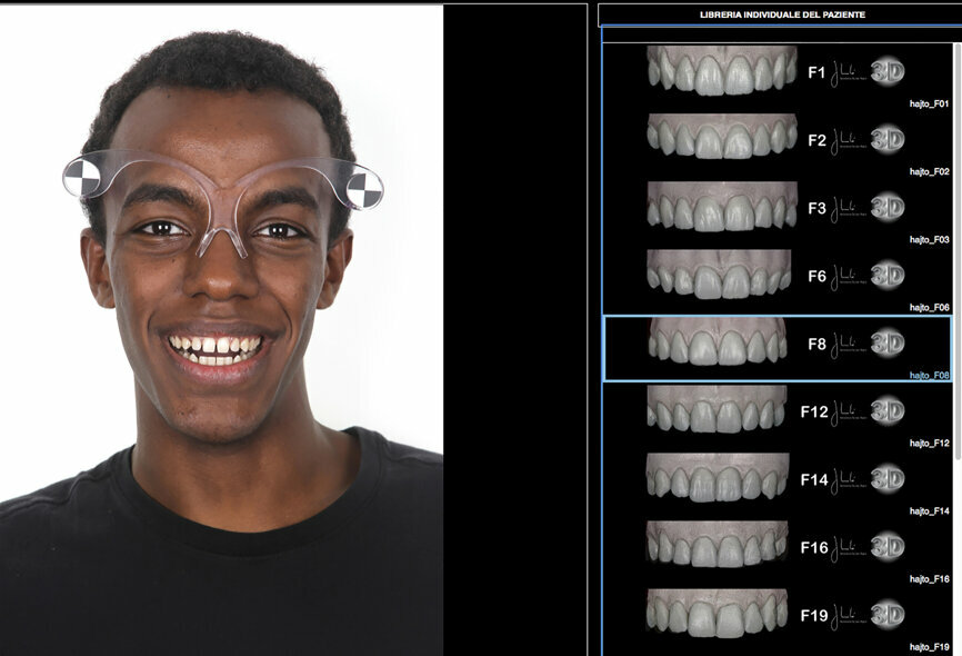 Fig. 12: Digital smile system glasses and digital dental library selected by the software for the smile planning.