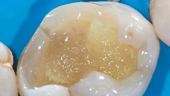 Biomimética na Odontologia - aplicabilidade dos materiais estéticos odontológicos