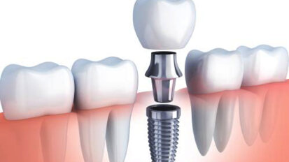 Los implantes dentales, entre los tratamientos odontológicos más demandados en 2020