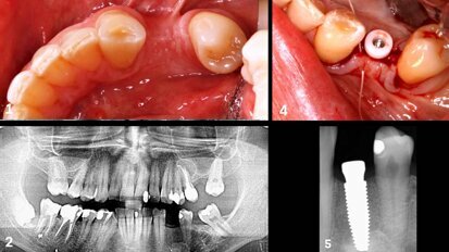 Rehabilitación unitaria en el premolar inferior con un implante cerámico