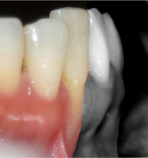 Fig. 5. Buccal positioning of a tooth/ implant will negatively impact root coverage , and needs to be carefully assessed.

