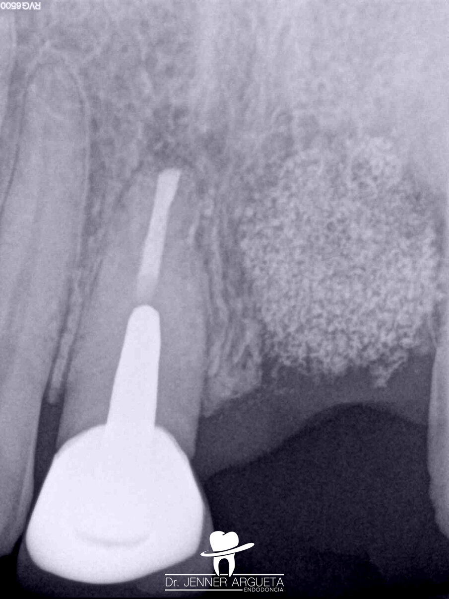 Fig. 13: Radiograph after periapical surgery showing the well-adapted and dense retro-obturation.