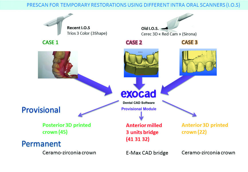 Fig. 1: Pre-scan for temporary restoration. Three-dimensional proprietary formats DCM (3Shape) and CDT (Sirona) can be imported in STL format in exocad open software after conversion and exported for fabrication (3D printing or milling) of the provisional restorations.