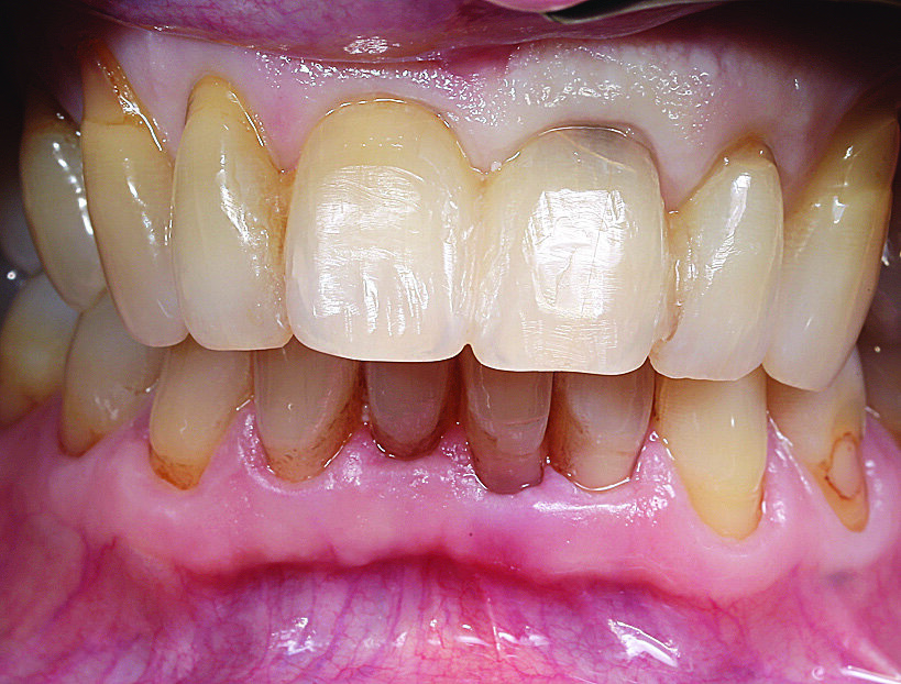Slika 5. Stanje nakon tri mjeseca: promjena boje na zubu 21 cervikalno