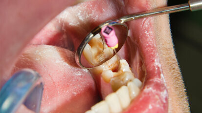 Specialised endodontic care remains challenge, FDI survey says